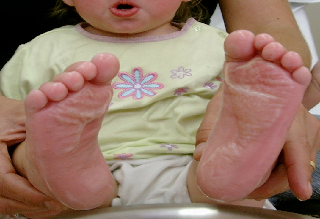SAQ24burntfeet
