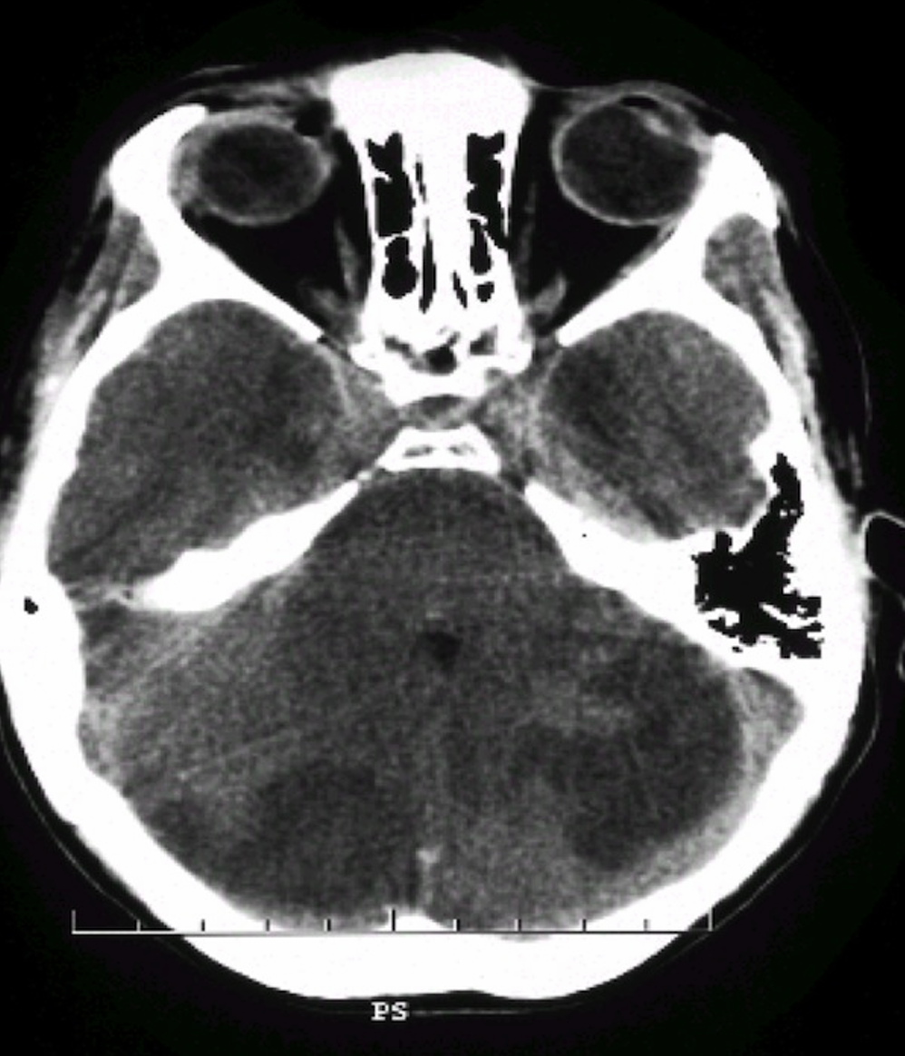 SAQ26vertiigoctb