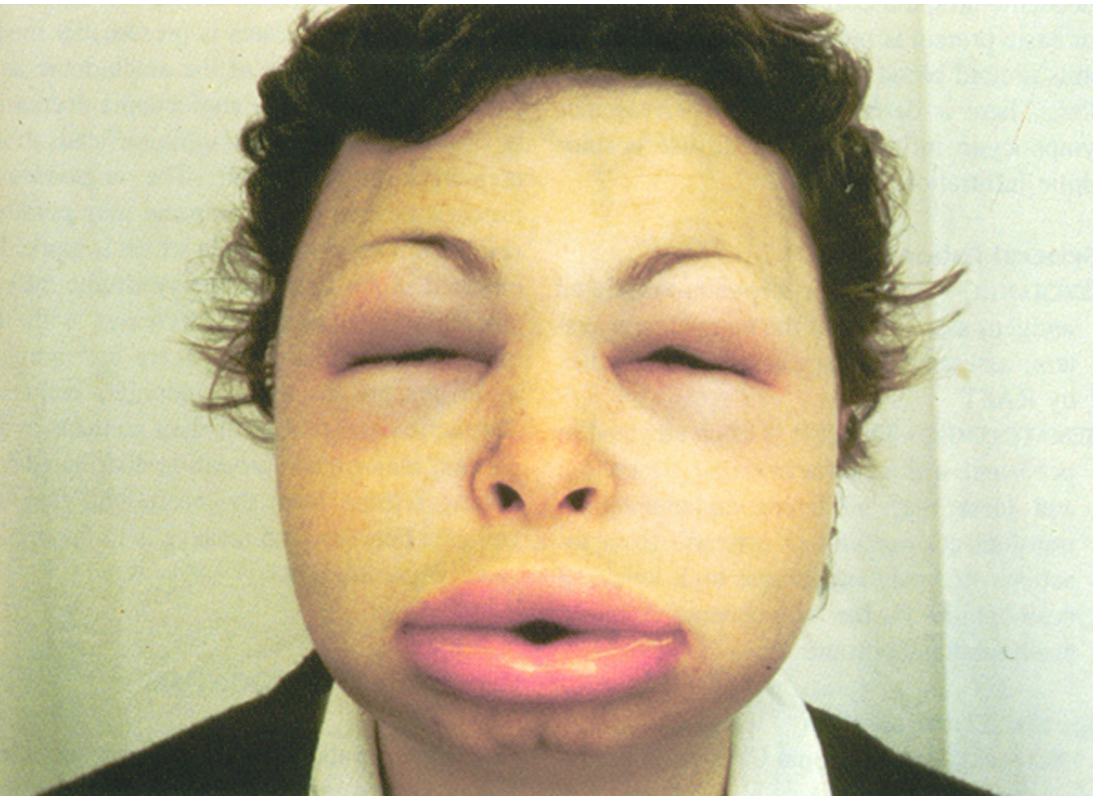 SAQ31swollenface
