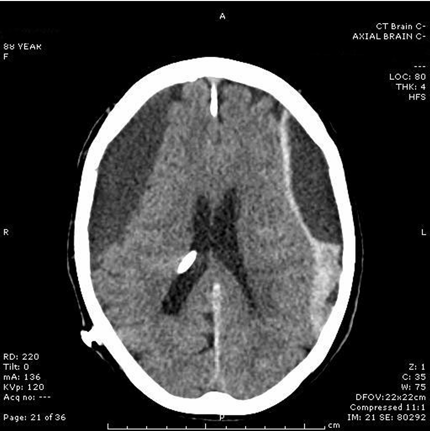 ctb-subdural