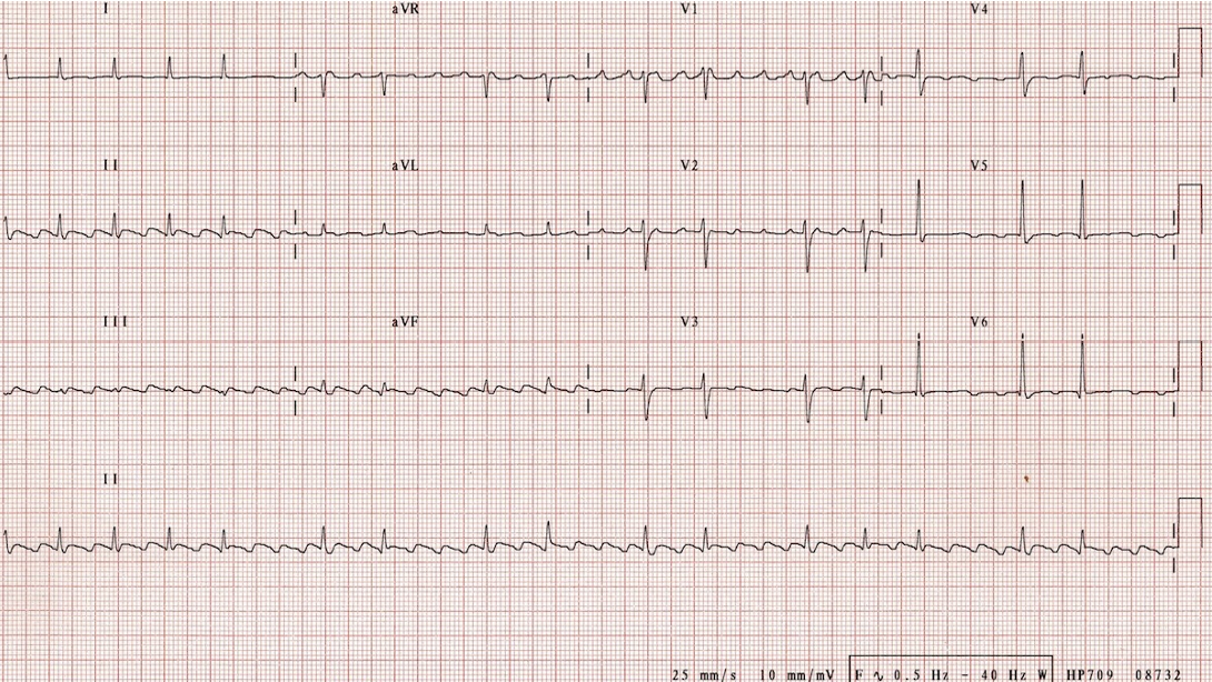 saq15flutterecg