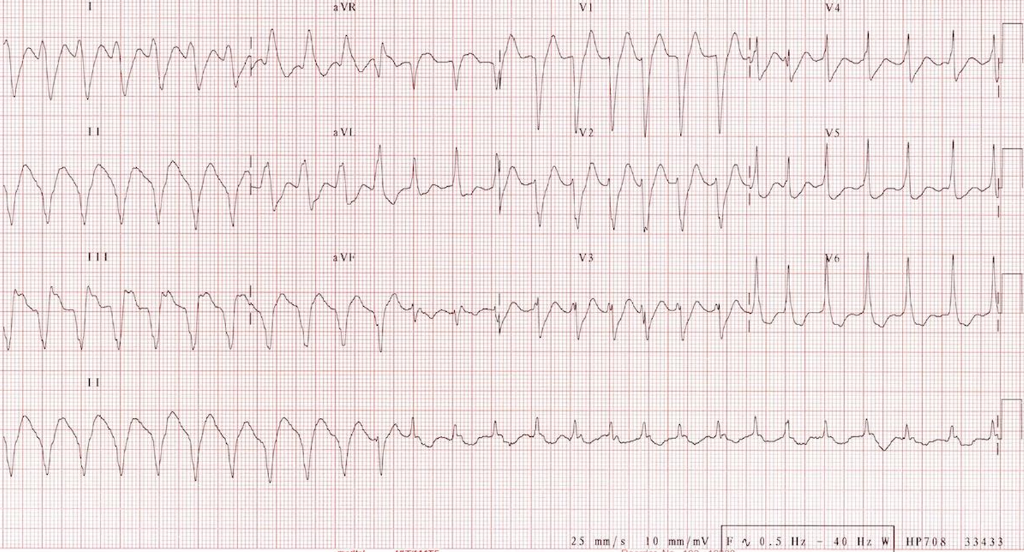 ecg23