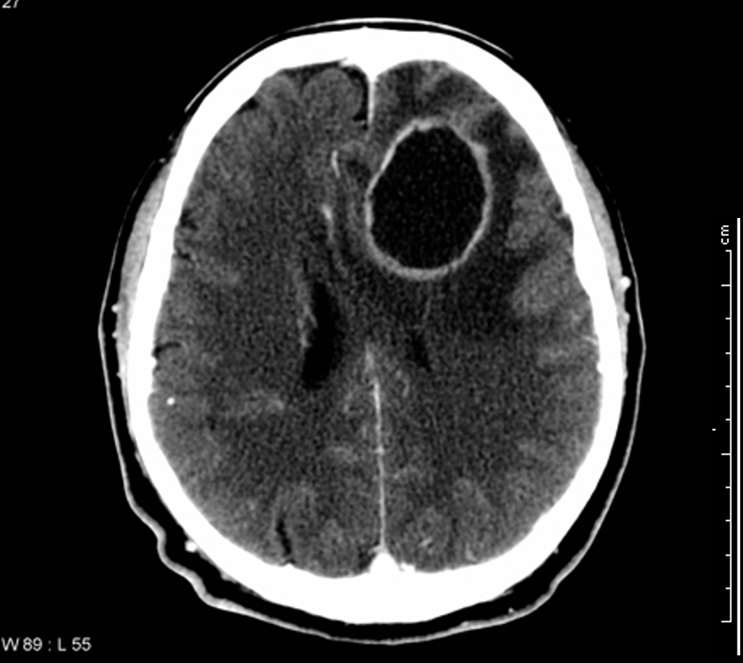 saq35ctbrain