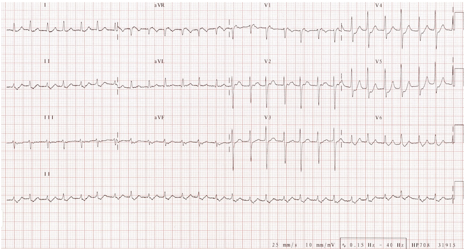 saq40alternans