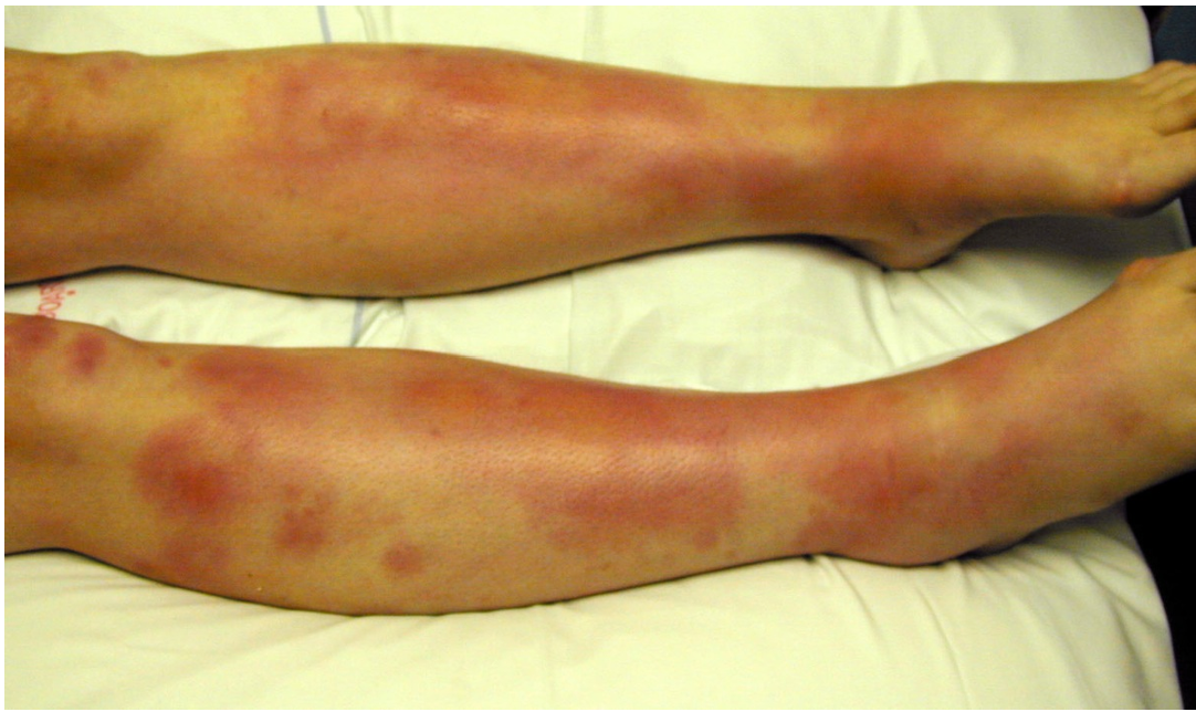 Erythema nodosum