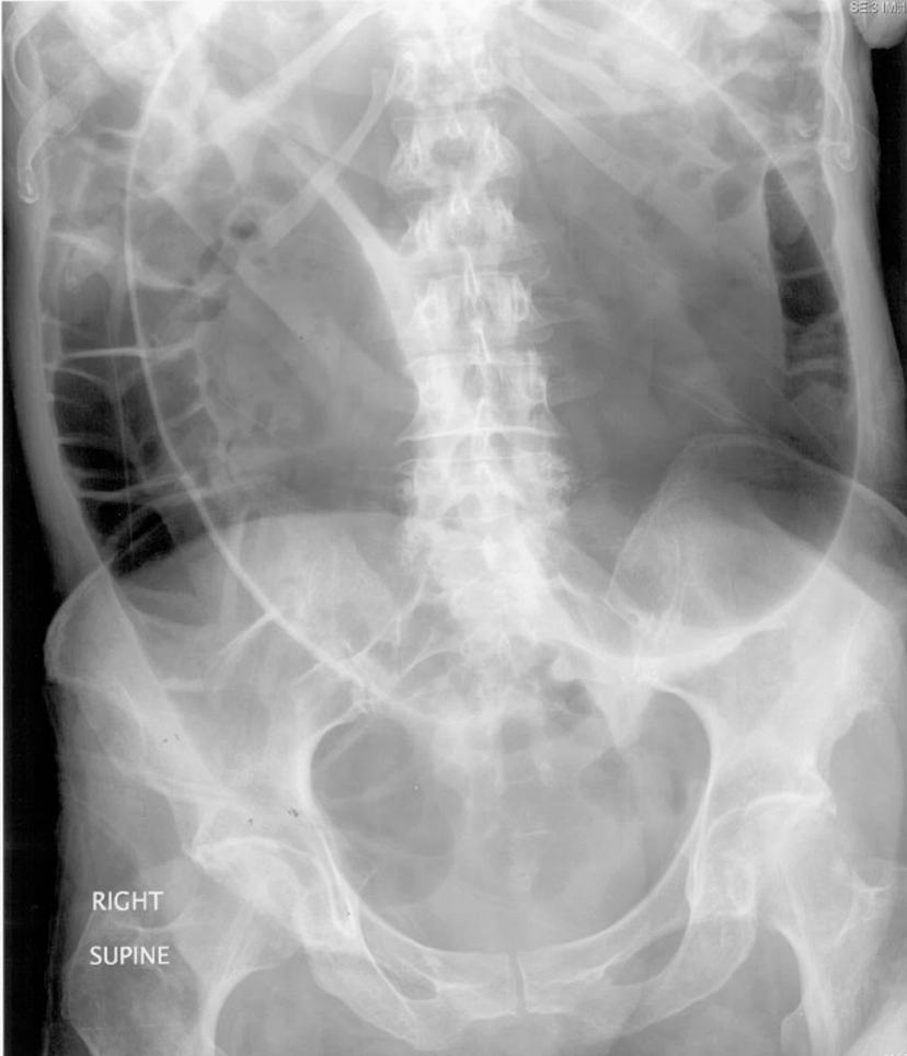 Abdominal X-ray showing sigmoid volvulus