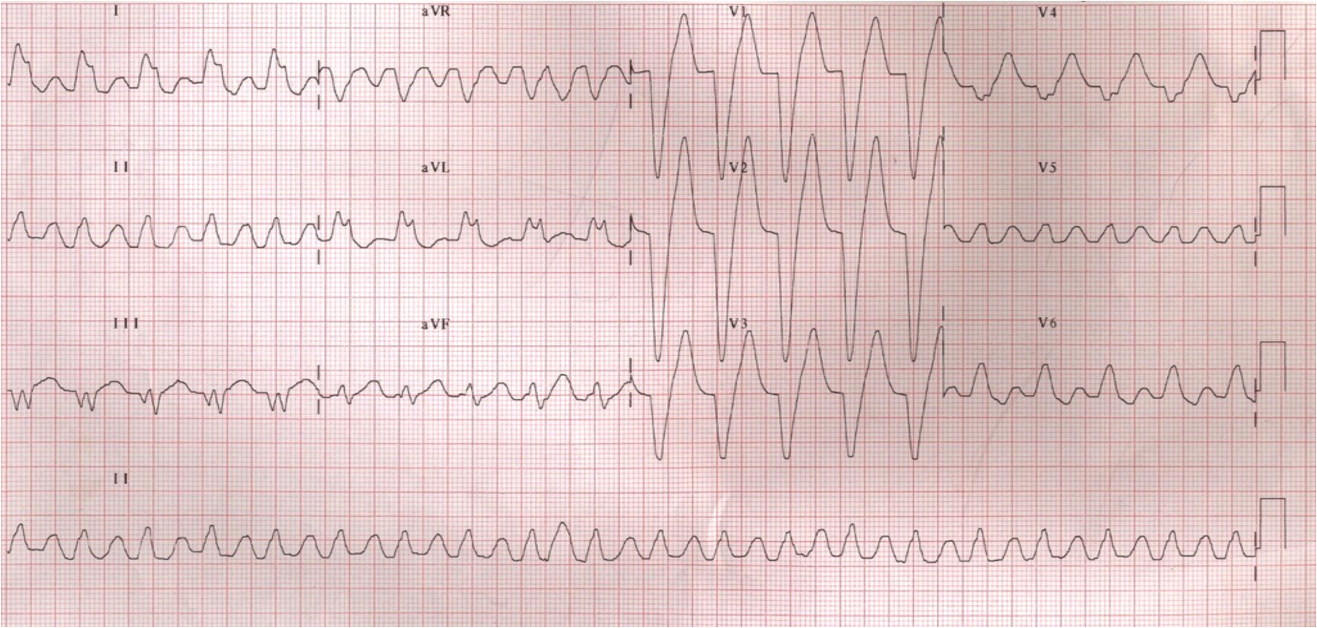 ECG for Geelong SAQ 007 question 5