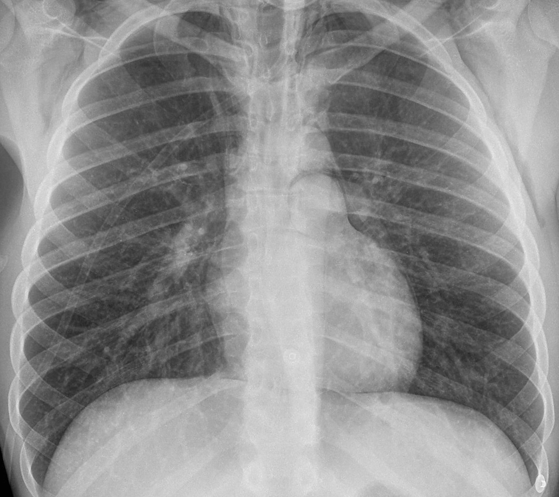Chest X-ray for Geelong SAQ 007 question 6