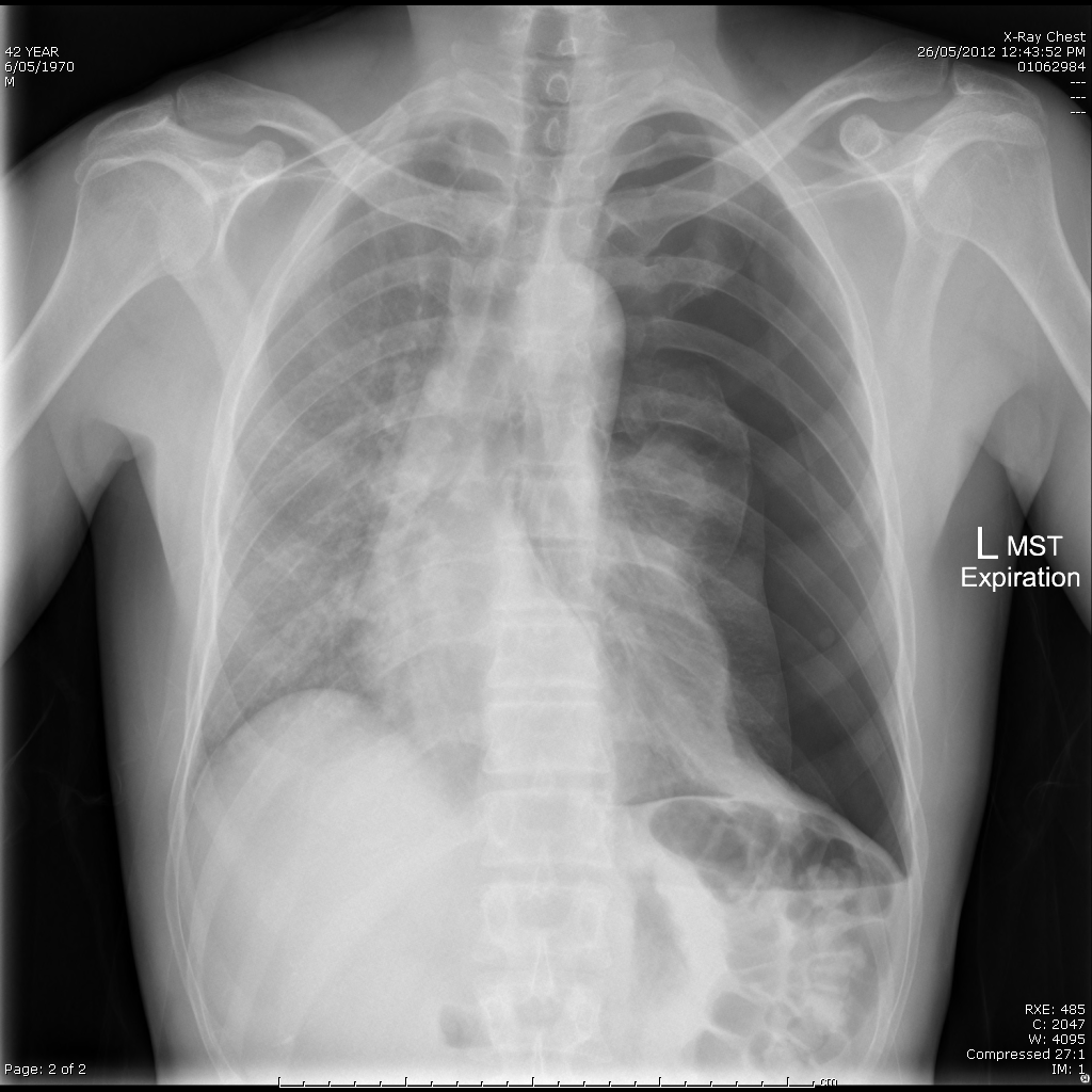 Chest X-ray for Geelong SAQ 008 question 5