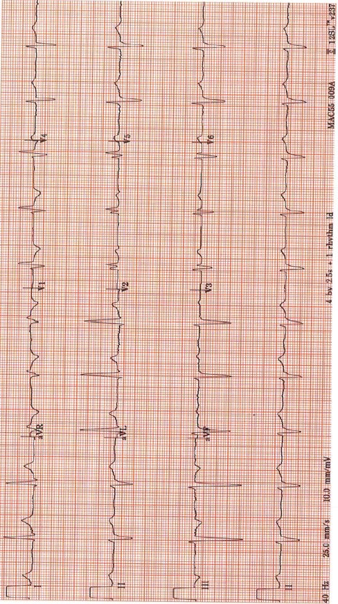 ECG for Geelong SAQ 008 question 6