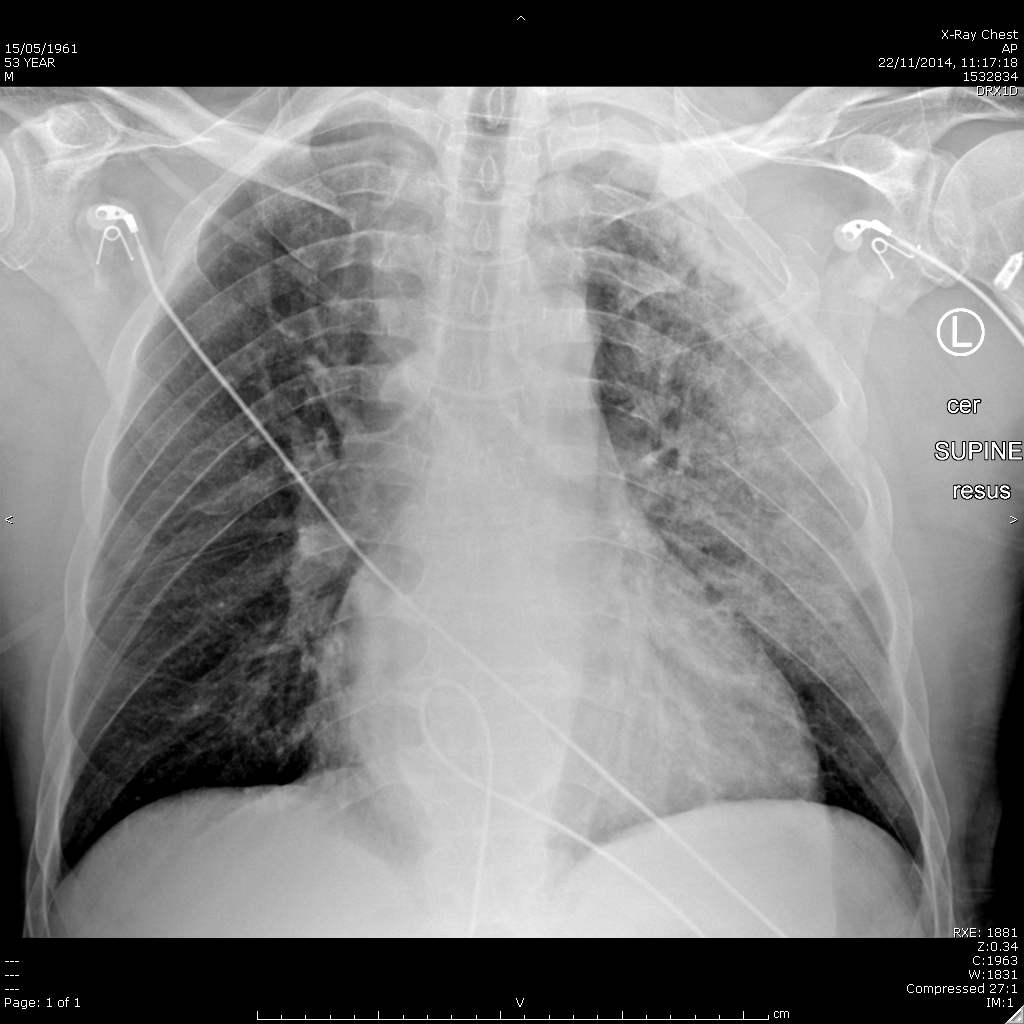Chest X-ray for Geelong SAQ 009 question 1