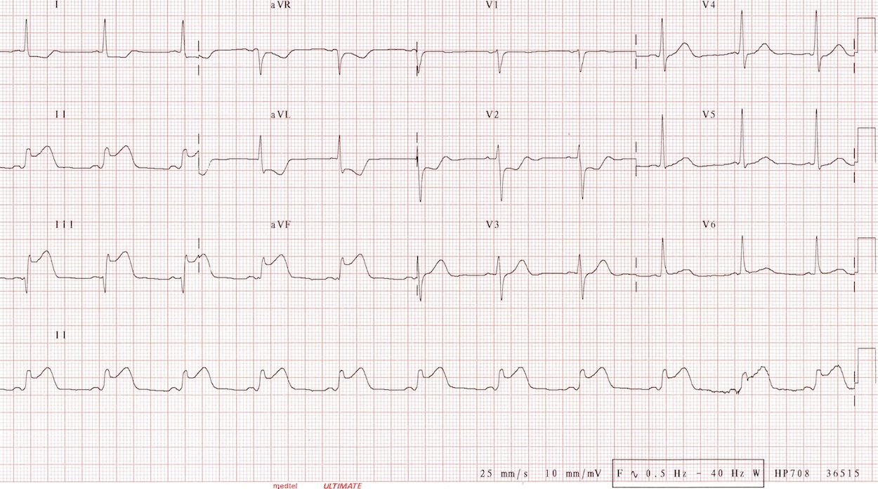 ECG for Geelong SAQ 009 question 5