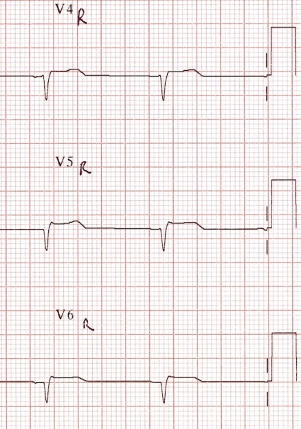 Right-sided ECG leads for Geelong SAQ 009 question 5