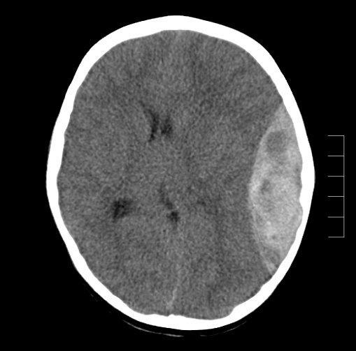 CT brain for Geelong SAQ 009 question 6