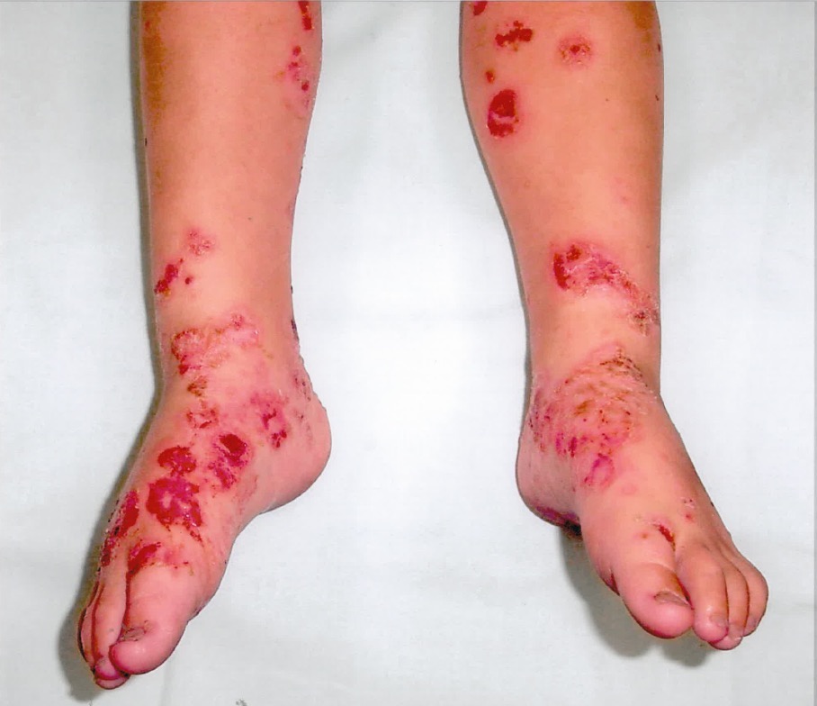 Lower limb rash photograph for Geelong SAQ 010 question 4