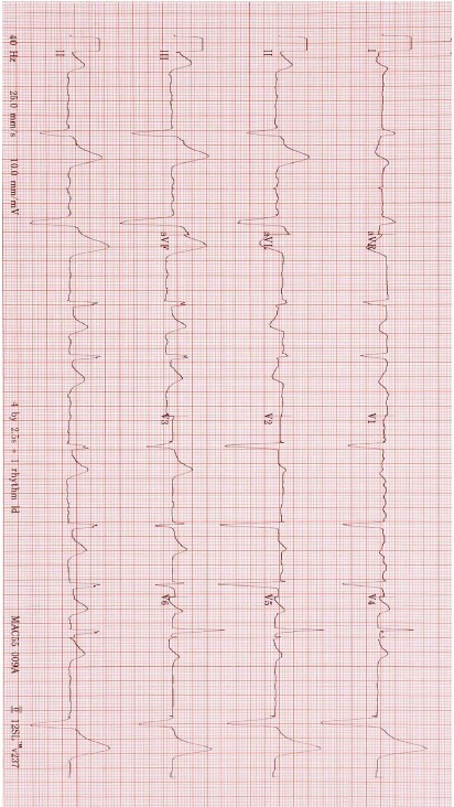 ECG for Geelong SAQ 010 question 5