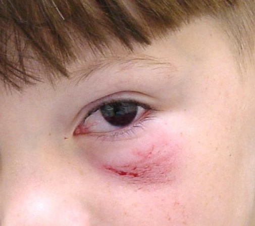 Eye injury photograph for Geelong SAQ 010 question 7