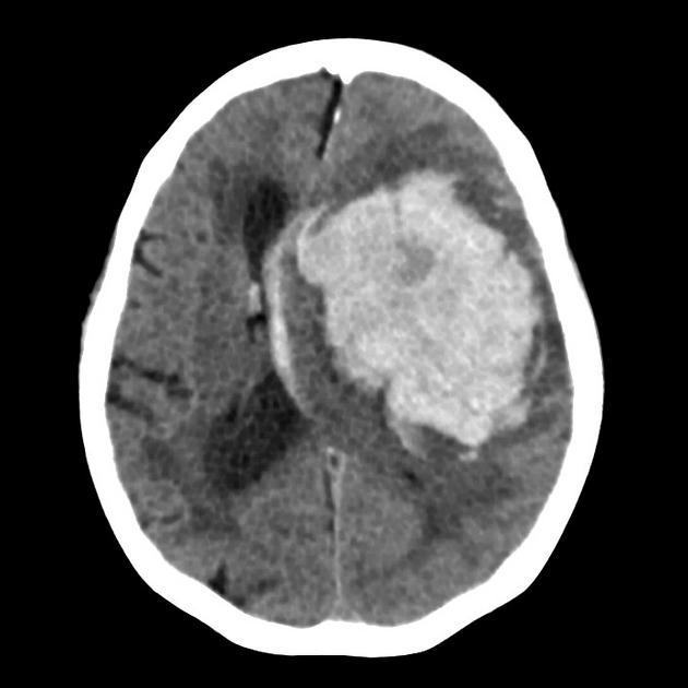 Axial CT brain showing a large left intracerebral haemorrhage with mass effect.