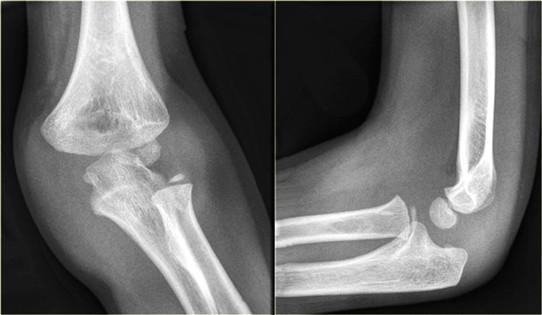 Paediatric elbow x-ray showing medial epicondyle avulsion and effusion.
