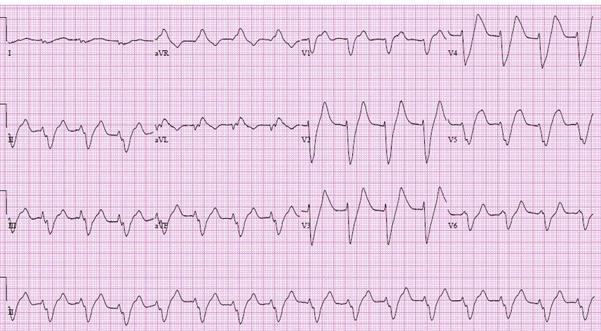 ECG showing severe hyperkalaemia features.