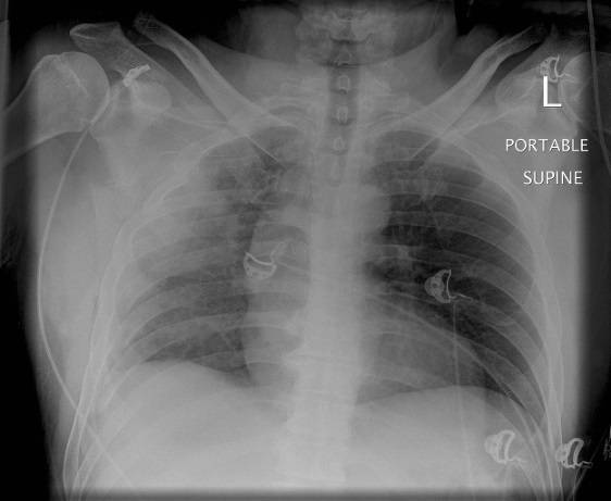 Chest x-ray after upper chest trauma