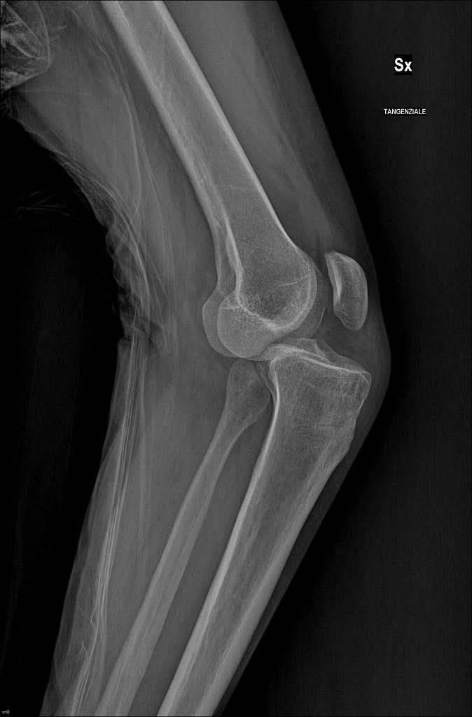 Lateral knee x-ray showing anterior dislocation