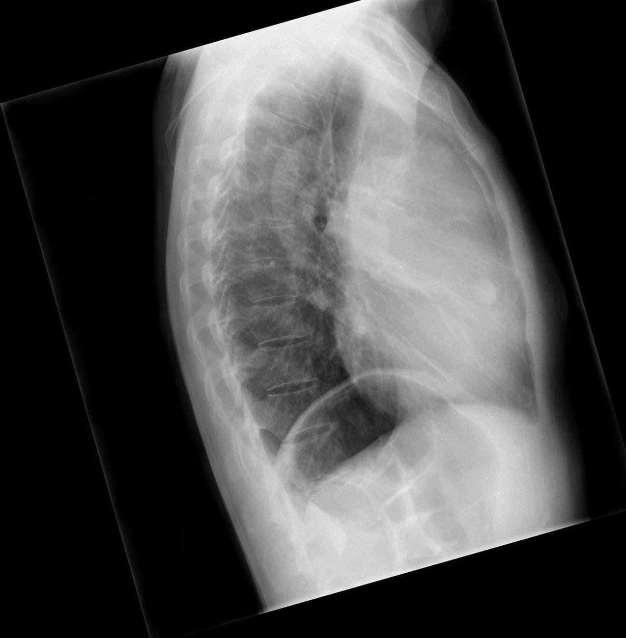 Lateral chest x-ray showing mediastinal mass