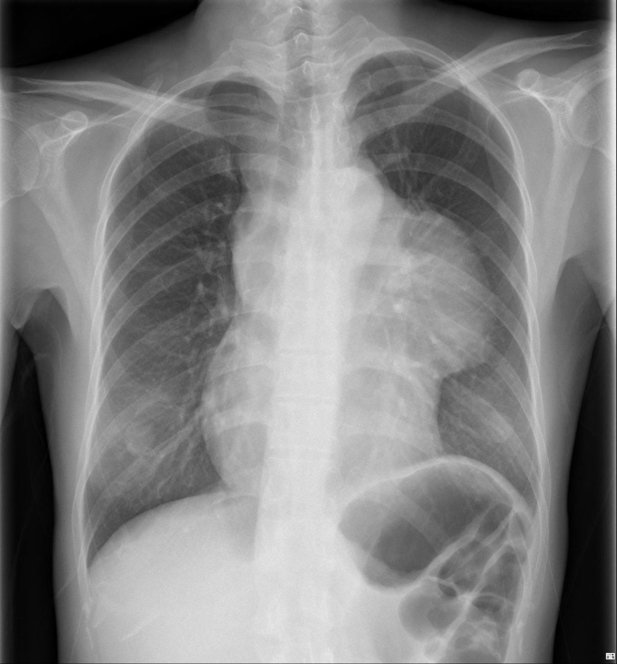 PA chest x-ray showing mediastinal mass