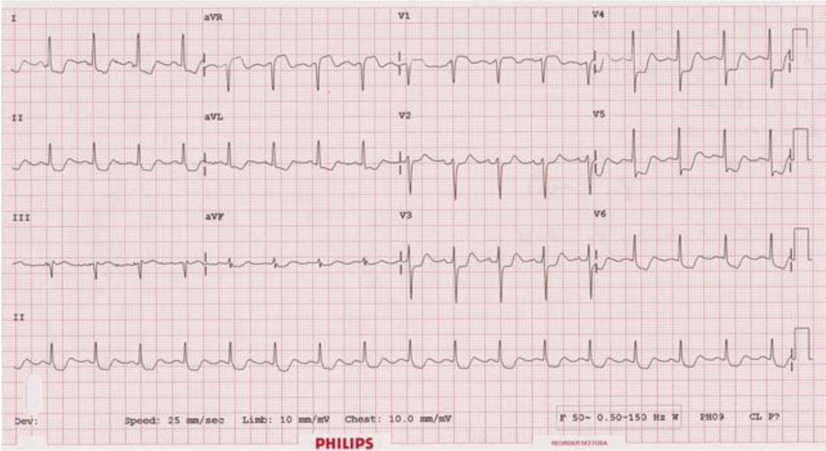 ECG for Geelong SAQ 011 question 4