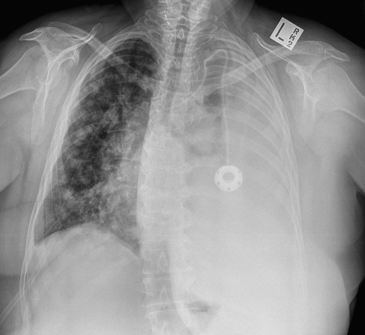 Chest X-ray for Geelong SAQ 011 question 5