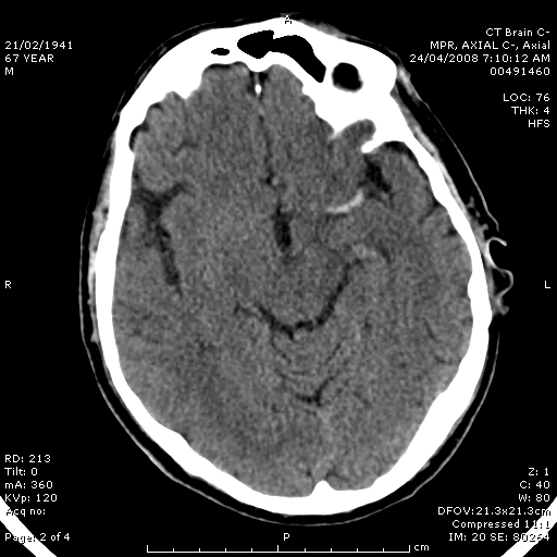 Non-contrast CT brain for Geelong SAQ 012 question 1