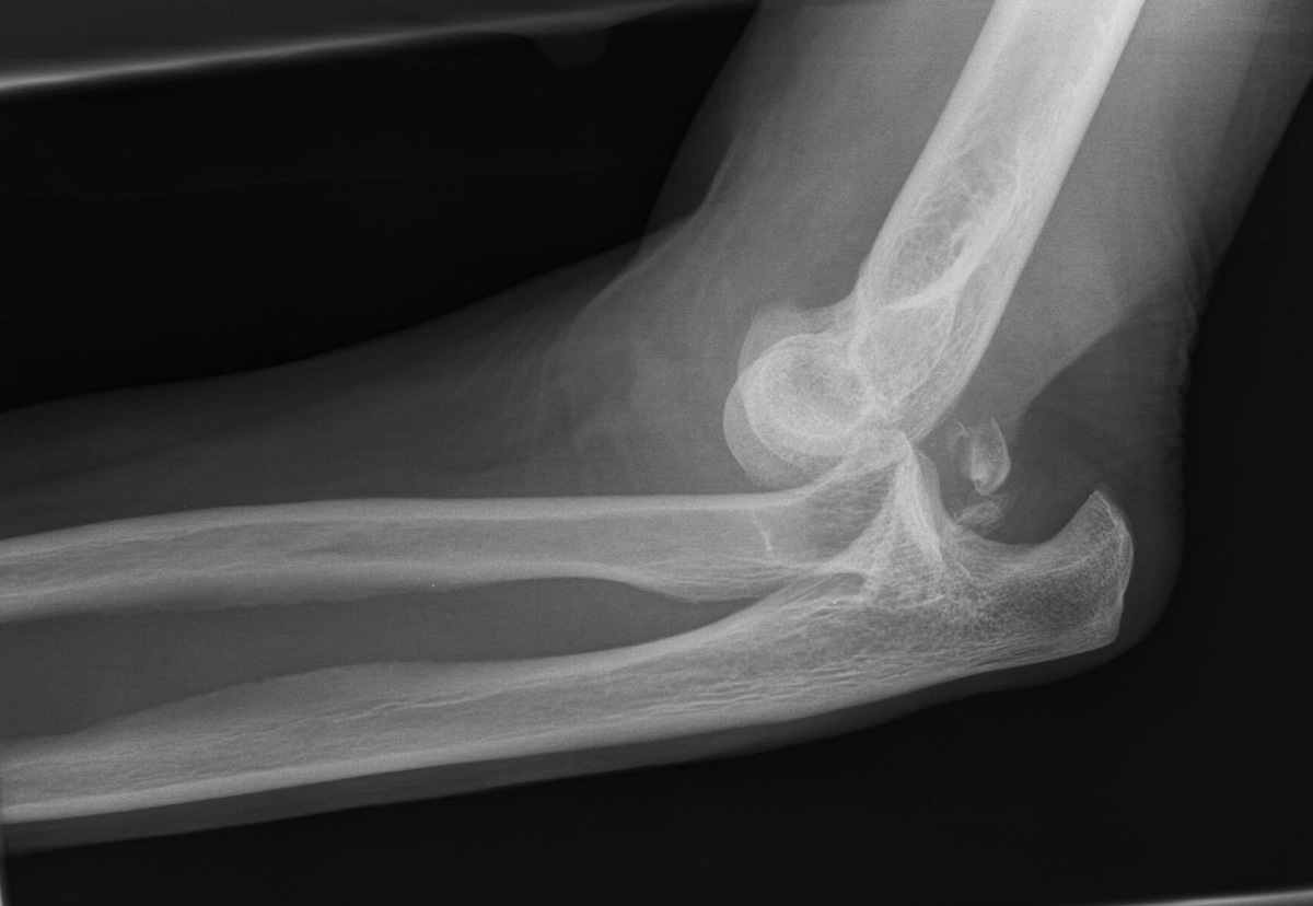 Elbow x-ray for Geelong SAQ 012 question 6