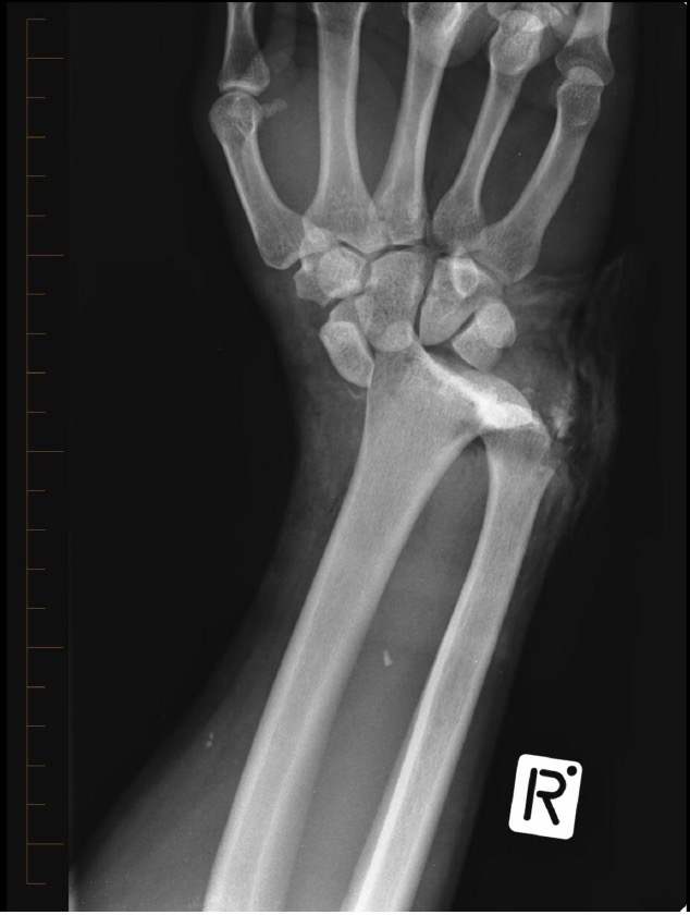 Wrist x-ray AP for Geelong SAQ 013 question 3