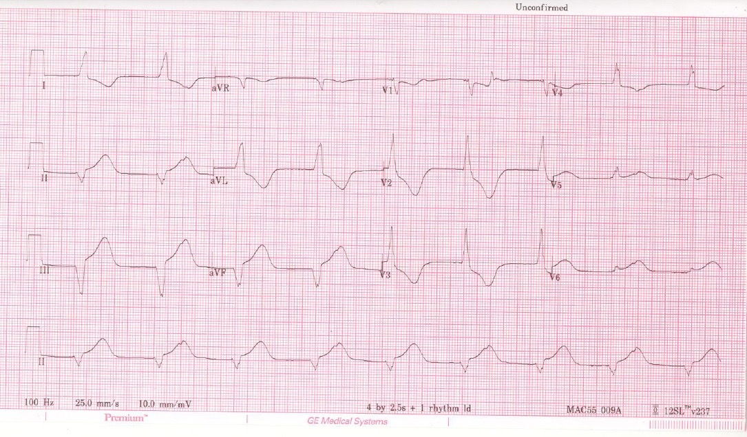 ECG after thrombolysis for Geelong SAQ 013 question 4