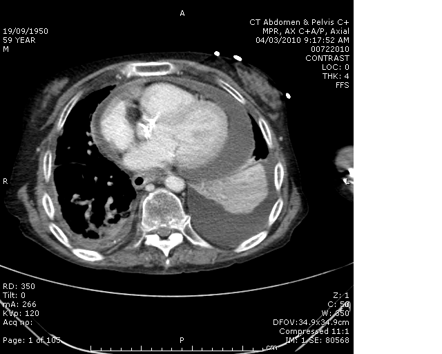 CT abdomen for Geelong SAQ 013 question 5