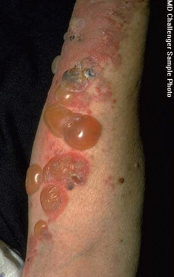 Photograph of bullous arm lesions for Geelong SAQ 013 question 7