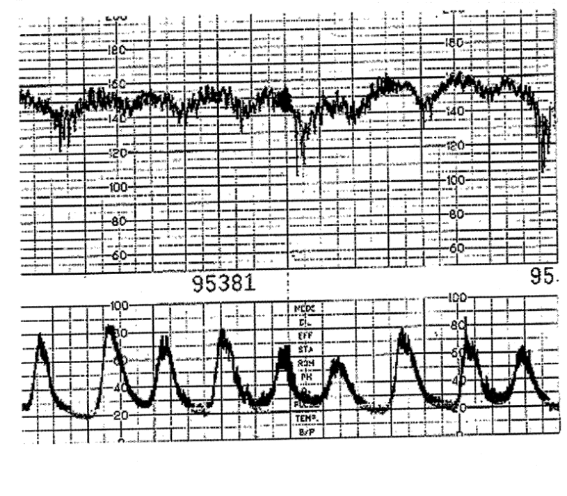 CTG monitoring trace for Geelong SAQ 013 question 9
