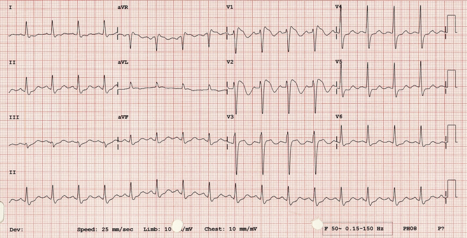 ECG for Geelong SAQ 014 question 1
