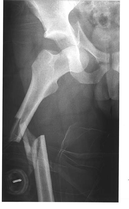 Hip and femur x-ray for Geelong SAQ 014 question 2