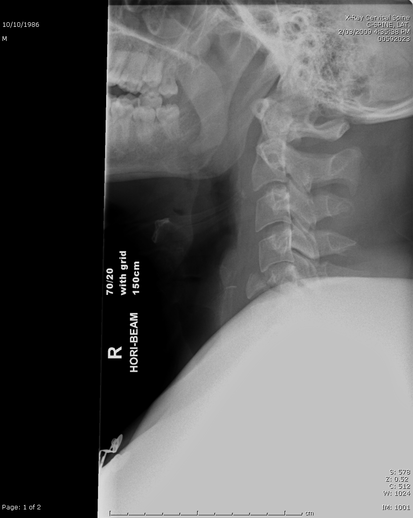 Lateral cervical spine x-ray for Geelong SAQ 014 question 6