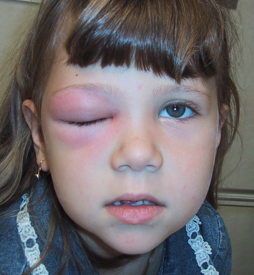 Photograph of right periorbital swelling for Geelong SAQ 014 question 8