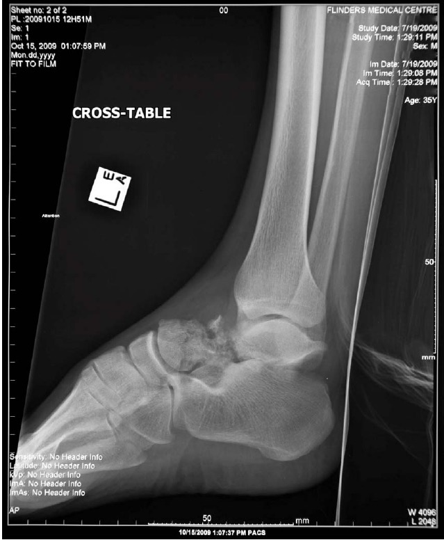 Left ankle x-ray lateral for Geelong SAQ 015 question 2