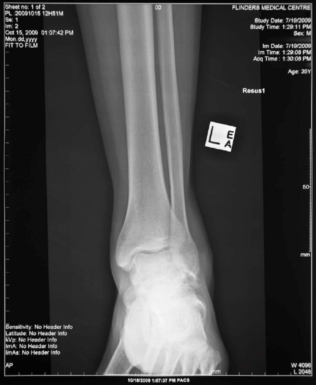 Left ankle x-ray AP for Geelong SAQ 015 question 2