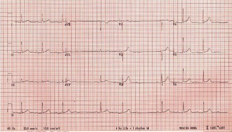 ECG 1 for Geelong SAQ 015 question 4