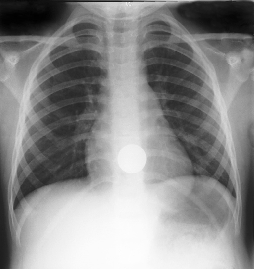 X-ray 1 foreign body for Geelong SAQ 015 question 5