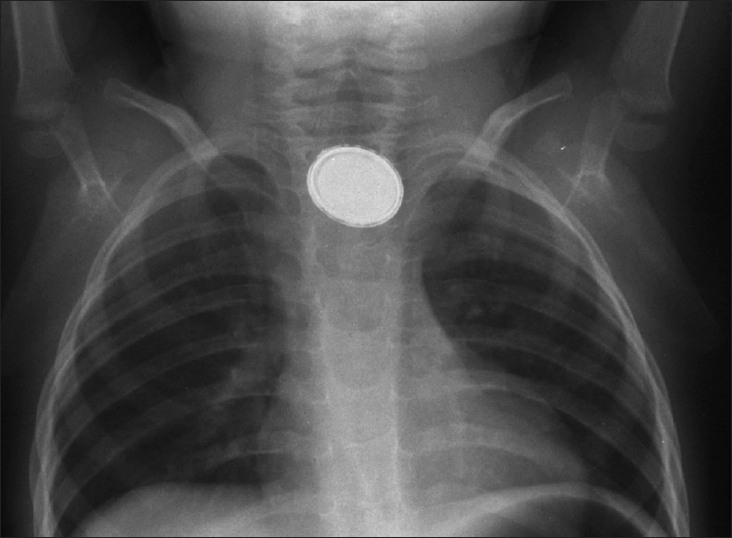 X-ray 2 foreign body for Geelong SAQ 015 question 5