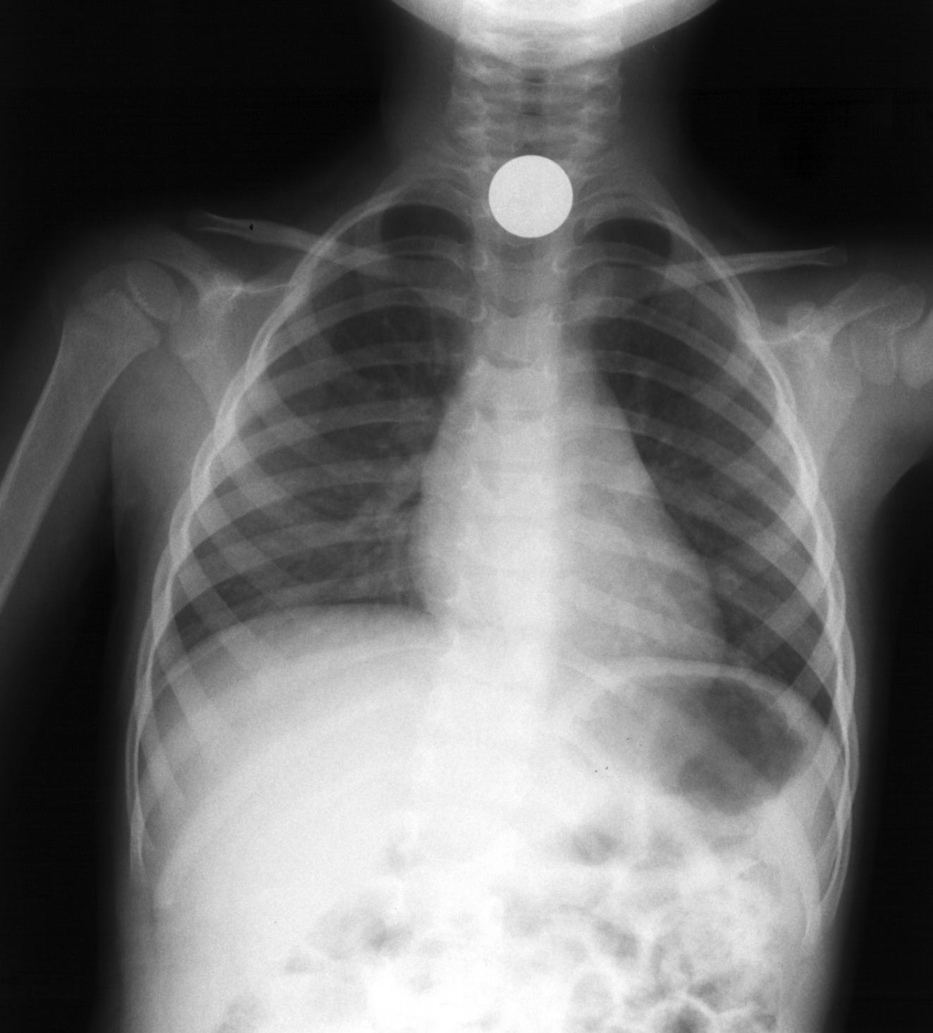 X-ray 3 foreign body for Geelong SAQ 015 question 5