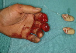 Photograph of left hand finger amputations for Geelong SAQ 015 question 7
