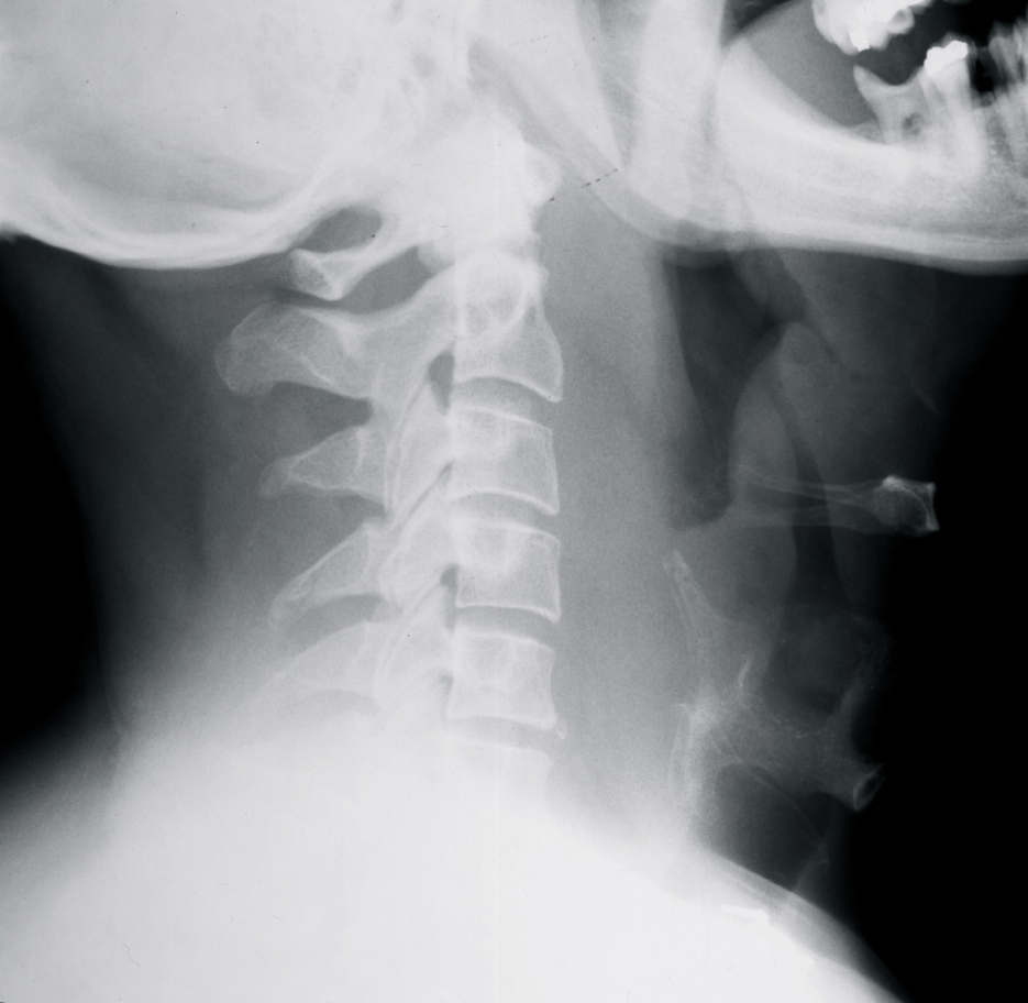 Lateral neck x-ray for Geelong SAQ 016 question 1