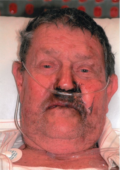 Facial burns photograph for Geelong SAQ 016 question 2